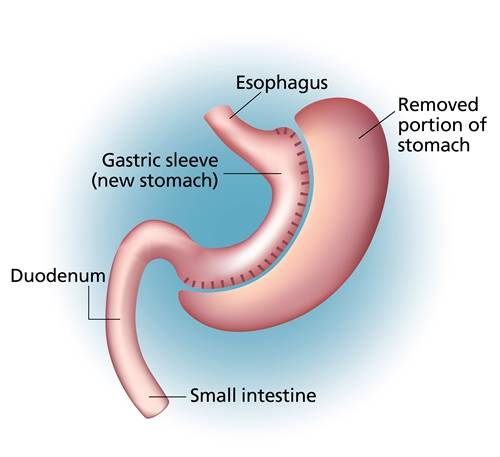 Gastric Sleeve (Sleeve Gastrectomy) Surgery